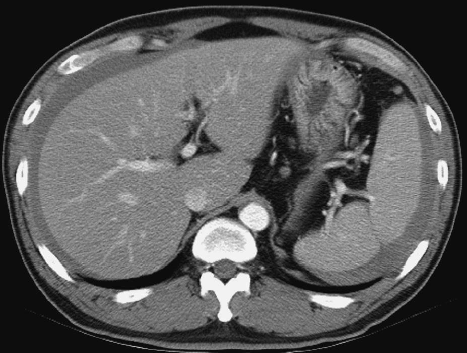 Splenic Rupture Common signs and symptoms: Nausea, malaise Pain radiating to left shoulder Blood Pressure Hematocrit