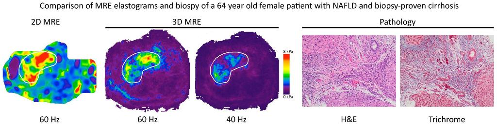 MRI Technology MRE for Fibrosis 2D and