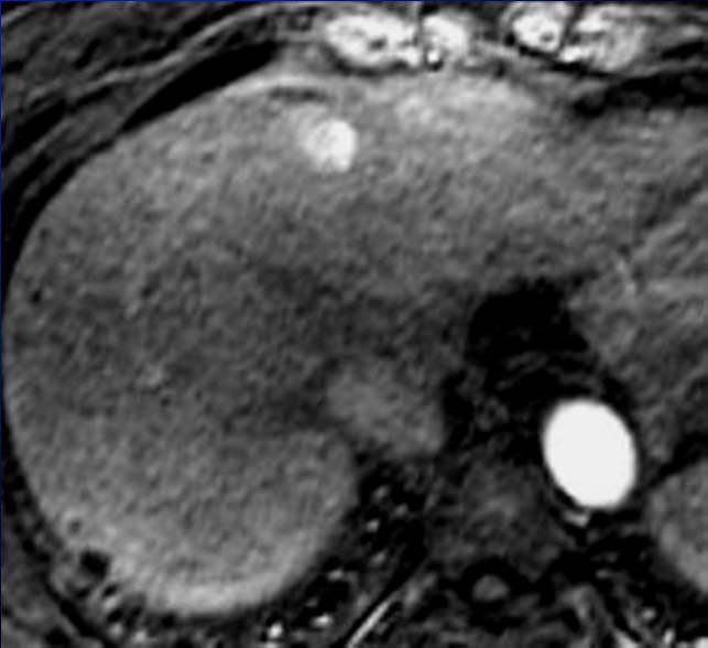 patients (33 HCCs) had prior MRI (6-24 months) 29/33 initially considered benign nodules or