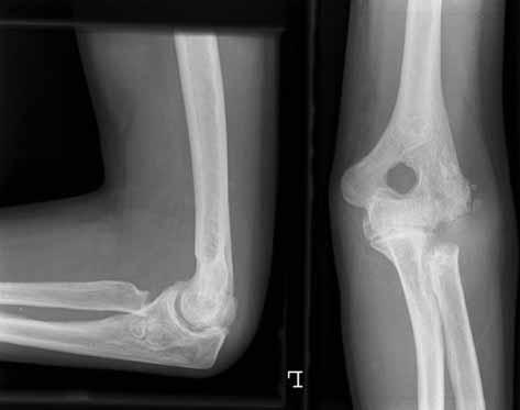 DEBRIDEMENT ARTHROPLASTY FOR OSTEOARTHRITIS OF THE ELBOW 309 a Fig. 3a. Severe osteoarthritis with multiple loose bodies, anteriorly and posterior-ly ; severely deformed radial head. b Fig. 3b.