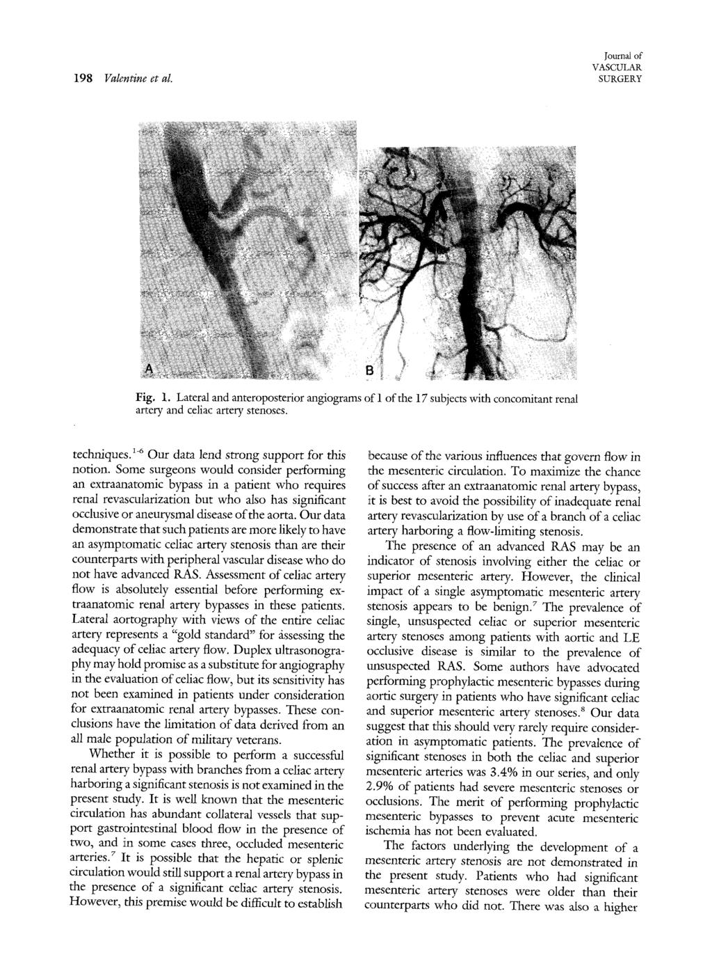 198 Valentine et al. Journal of VASCULAR SURGERY Fig. 1. Lateraland anteroposterior angiograms ofl ofthe 17 subjects with concomitant renal artery and celiac artery stenoses. techniques.