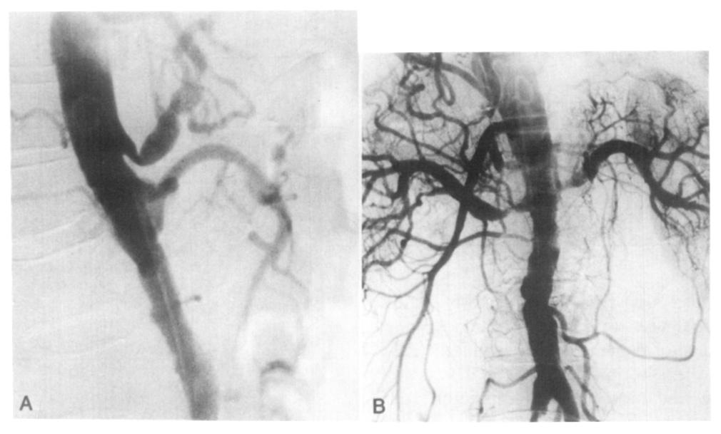 Some surgeons would consider performing an extraanatomic bypass in a patient who requires renal revascularization but who also has significant occlusive or aneurysmal disease of the aorta.