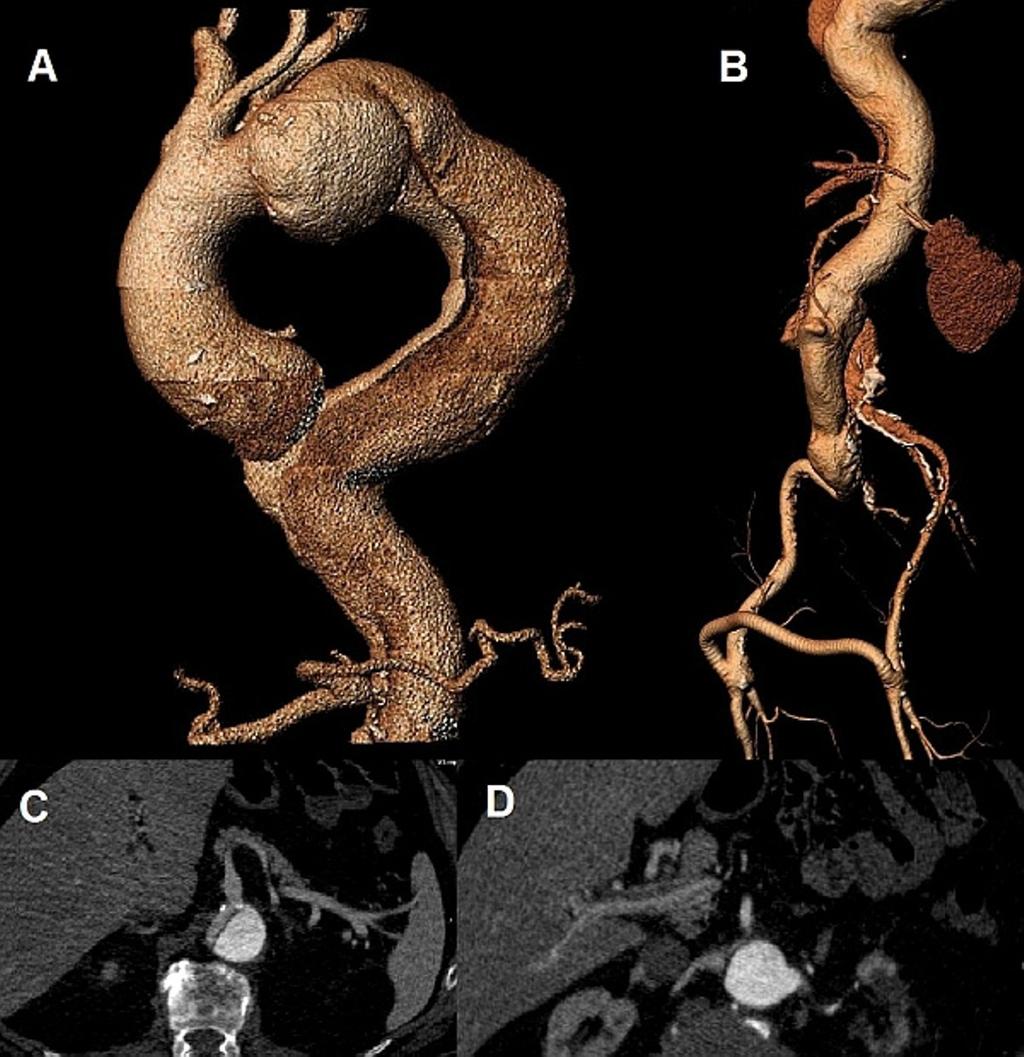 Page 2 of 5 Figure 1 Pre-operative images of the aorta. (a.) 3D CT reconstruction demonstrating the dissecting type B aneurysm and the dilatation of the arch and ascending aorta (b.