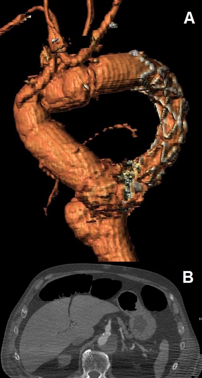 Page 4 of 5 Figure 2 Postoperative images of the aorta. (a.