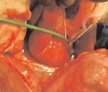 with abdominal aortic aneurysms by preventing the need for open surgical repair.