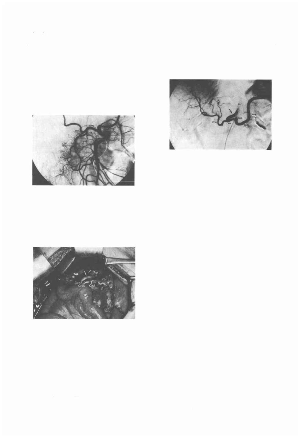 Fig. 4 Superior mesenteric angiogram demonstrates high-grade stenosis of the celiac axis at its origin and the blood supply to the celiac artery being sustained through the gastroduodenal artery via