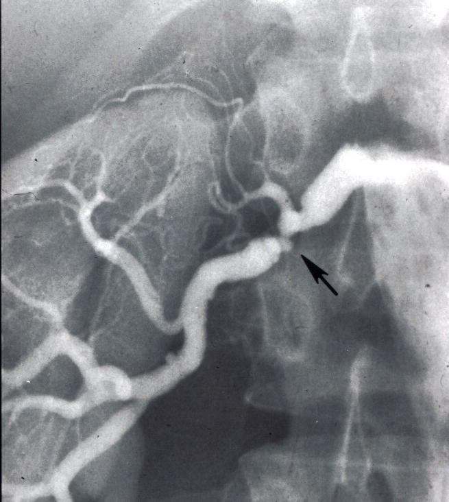 Most common angiographic variant > 85% of cases Multiple areas of stenosis