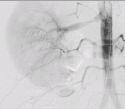 Sausage links < 10% of cases Variable angiographic appearance Focal, severe