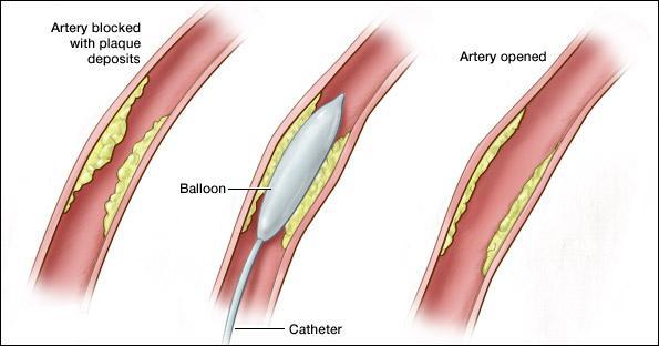 mounted on a catheter Usually the