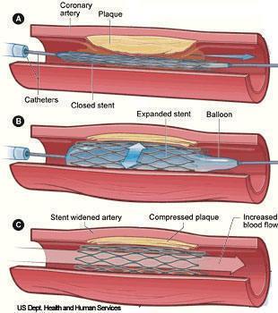 Stent Artifical tube inserted into a natural passage in the body Vascular stents are metallic,