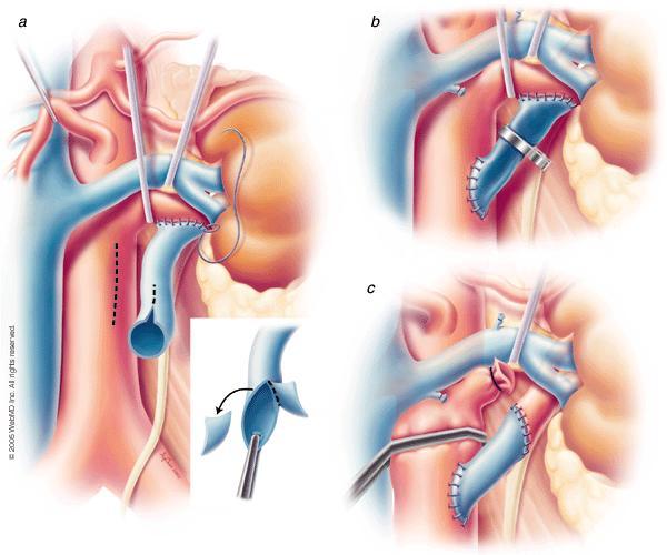 Bypass Surgery Surgical procedure where an artery or