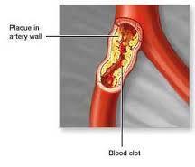 Atherosclerosis Hardening, thickening, and narrowing of arteries due to