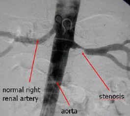Arterial stenosis