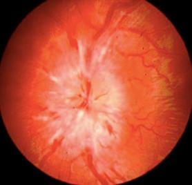 Visual loss in GCA Double vision (cranial nerves III, IV, VI) Transient visual loss can precede permanent loss: Amaurosis fugax