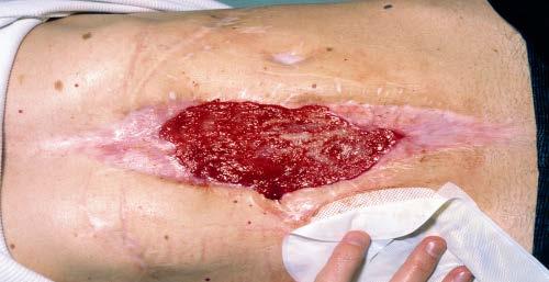 Sloughy Necrotic Infected Objectives: Fluid absorption, thermal insulation, moisture control. To encourage angiogenesis and promote wound healing.