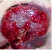 Granulation incorporates a dense network of blood vessels and newly growing capillaries with an irregular upper layer created by the capillaries looping together on the wound surface.