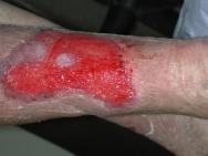 Diabetic foot ulcer a