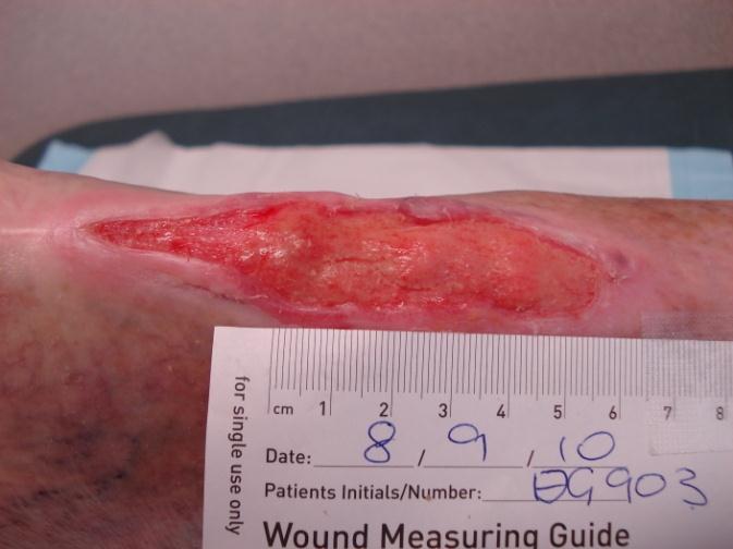 proteases in wound beds Research show a
