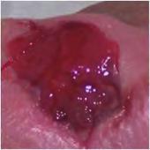 Area Drug and Therapeutics Committee Overgranulation An essential aspect of secondary intention wound healing is the proliferation of granulation tissue, (McGrath, 2011).