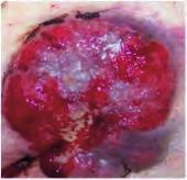 The wound will not continue to heal as the presence of this tissue will prevent the migration of epithelial tissue across the wound bed. The exact cause of overgranulation is unknown, (Russell 2000).