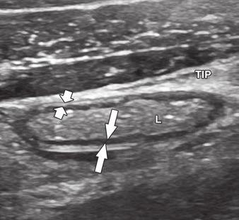 Xu et al. pria (i.e., lymphoid hyperplasia) is associated with an increased likelihood of false-positive sonographic diagnoses of appendicitis among patients with 6- to 8-mm noncompressible appendixes.