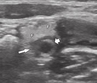 , Longitudinal sonographic image shows thickened hypoechoic lamina propria (between long arrows), consistent with lymphoid hyperplasia. Note hyperechoic periappendiceal fat (F).