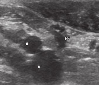 Calipers mark mid appendix., Transverse sonographic image near appendiceal tip shows adjacent hyperechoic periappendiceal fat (F).
