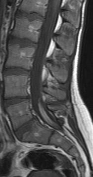 puncture headache Received epidural blood patch hypointense, hyperintense nonenhancing intrathecal mass Presumably an iatrogenic thrombus risk of arachnoiditis Unknown Case