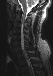 spine AXIAL C3 LEVEL Case #1 AXIAL C6 LEVEL Patient: 34