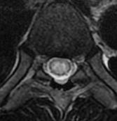 beyond tumor margins Rare: intradural, extramedullary Which of the following statements about spinal ependymomas is NOT true?