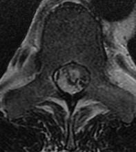 Dysraphism or dermal sinus tract usually present in children with spinal