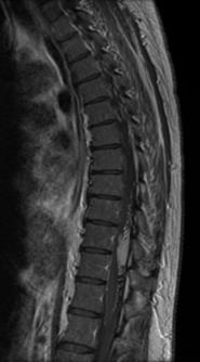 lesion AXIAL T9 LEVEL Case #4 Intramedullary Lesion Imaging Findings: