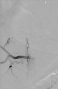 Case #4 Intramedullary Lesion Imaging Findings: DSA for preoperative embolization; sequential