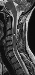 is TRUE regarding spinal hemangioblastomas?