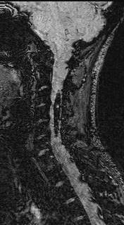 Associated VHL gene is located on chromosome 5 D: 75% of patients with VHL have a spinal