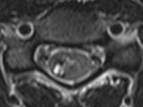 significant cord edema, hypointense rim on axial imaging; susceptibility artifact on SWI SWI