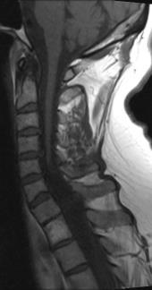 enlargement 2) Cord destruction from primary process cavitation Case #6 Syringomyelia Hydromyelia cystic central cord canal dilatation (lined by ependyma) Syringomyelia paracentral cystic cavity that