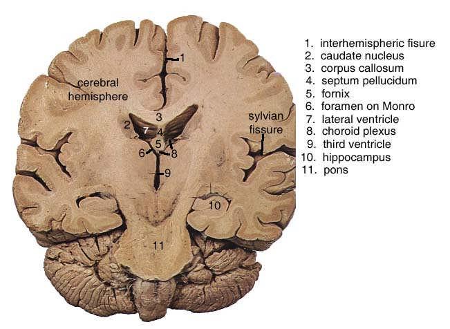 74 Coronal section though the brain demonstrating major anatomical landmarks with sonographic correlation.