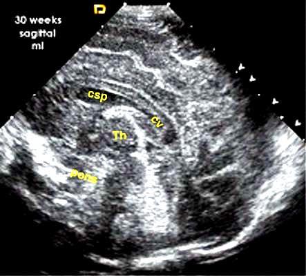 This closure progresses to complete obliteration of the cavum septi pellucidi in 85% of infants by age 2 months.