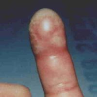 Felon A closed-space infection of distal pulp of finger. It presents with swelling and tension in fingertip pulp.