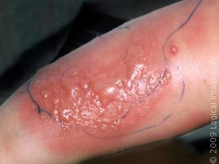 Cellulitis A localized area of soft tissue inflammation with skin infiltration with white cells, capillary dilatation and proliferation of bacteria.