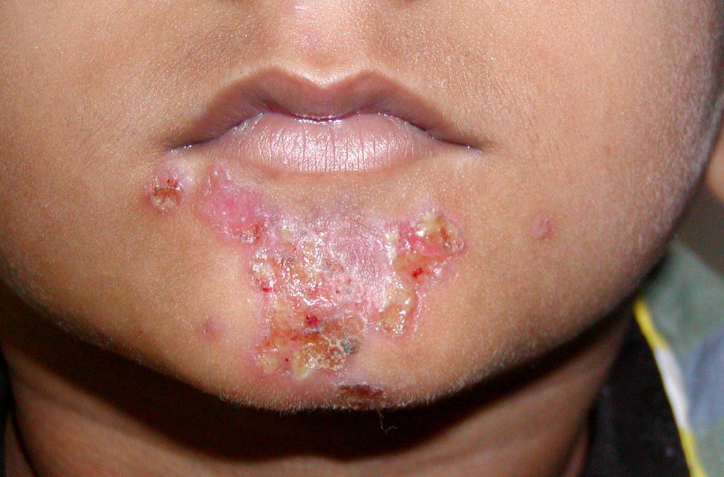 Impetigo Superficial skin infection caused by Staph aureus (80%), B-hemolytic strep (10%) or both.