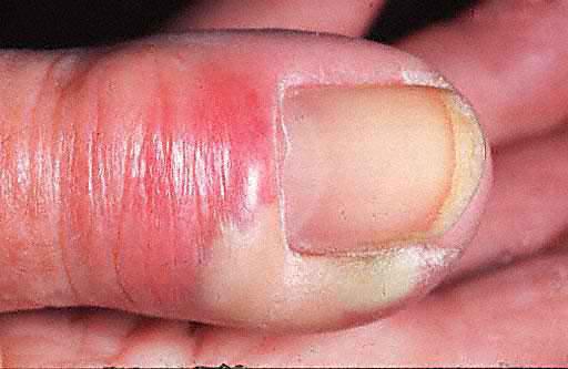 Paronychia Trauma to the cuticle allows entry of bacteria. Nail biting, manicuring etc.