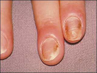 Treatment Acute infections may need decompressed by incision, usually parallel to the nail fold but entering the cuticle proximally.