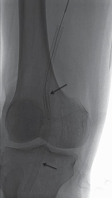 was identified in seven limbs at 3-month follow-up (Type 1, Type 2, Type 3 and multiple; n = 1, n = 4, n = 1 and n = 1, respectively), including one of 10 limbs that underwent stent placement up to