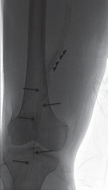 Patency and Fracture Rates of Popliteal-Artery Self-Expandable Nitinol Stents in Terms of Their Locations (P2 vs. P3) Fig. 3. 87-year-old man had diabetes with resting pain in his right foot.