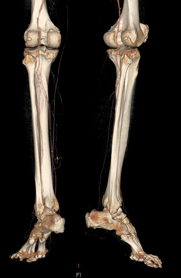 Below the knee diseases - Low profile (0.014 or 0.