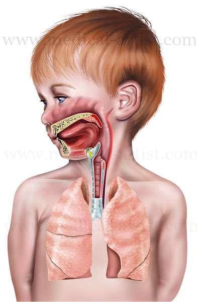 Choanal atresia Nasal masses Craniofacial Micrognathia Glossomegaly IM Retropharyngeal abscess Caustics Vascular compression FB Bacterial tracheitis TOF Bronchiolitis