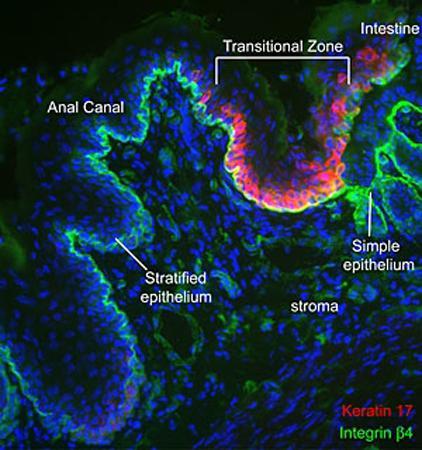 HPV infection and the anal canal 1983: Areas of epithelial transformation susceptible to HPV infection share similarities with transformation zone (TZ) of cervix This epithelium undergoes metaplasia