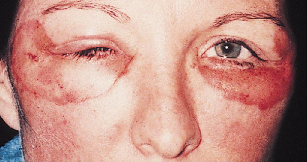 Figure 5. Subject with swelling, 1 day after resurfacing. Subject's right side was treated with the carbon dioxide laser (fluence, 5 and 3.